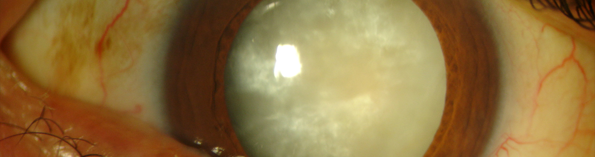 Cataract example